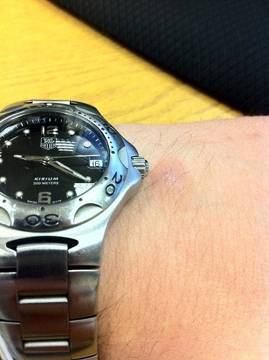 The Sign of a True Watch Collector: The Calluses on the Hand from Wearing Timepieces